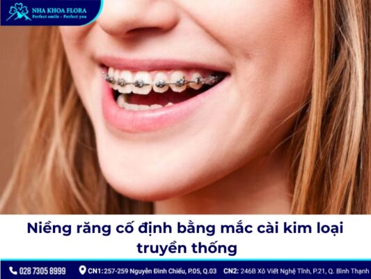 niềng răng cố định - ảnh 2 niềng răng cố định - ảnh 2