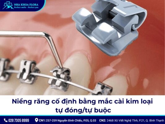 niềng răng cố định - ảnh 3 niềng răng cố định - ảnh 3