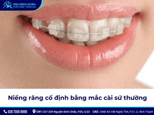 niềng răng cố định - ảnh 4 niềng răng cố định - ảnh 4
