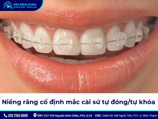 niềng răng cố định - ảnh 5 niềng răng cố định - ảnh 5