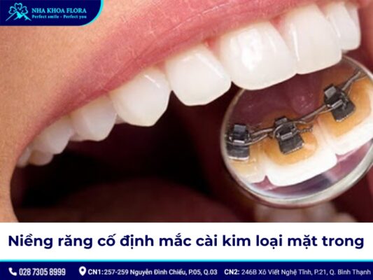 niềng răng cố định - ảnh 6 niềng răng cố định - ảnh 6