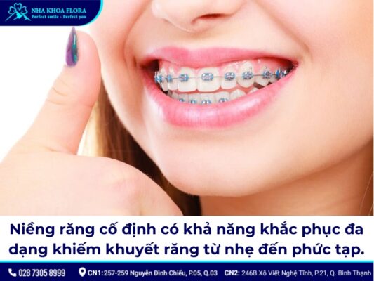 niềng răng cố định - ảnh 7 niềng răng cố định - ảnh 7