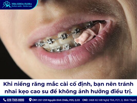 niềng răng cố định - ảnh 8 niềng răng cố định - ảnh 8
