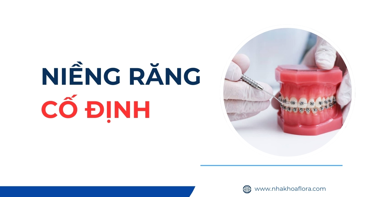 Niềng răng cố định là gì? Có hiệu quả không? Giá bao nhiêu?
