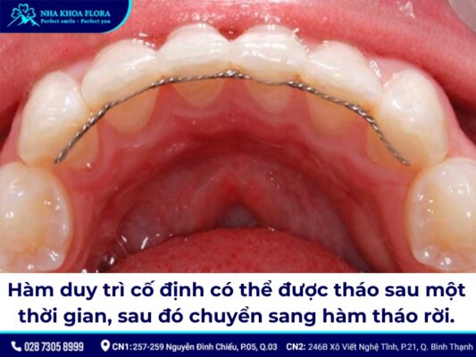 niềng răng đeo hàm duy trì bao lâu - ảnh 3 niềng răng đeo hàm duy trì bao lâu - ảnh 3