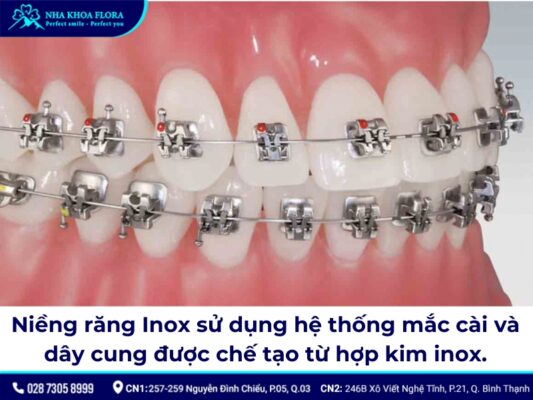 niềng răng inox đơn giản - ảnh 1 niềng răng inox đơn giản - ảnh 1