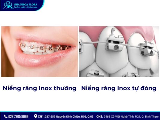 niềng răng inox đơn giản - ảnh 2 niềng răng inox đơn giản - ảnh 2