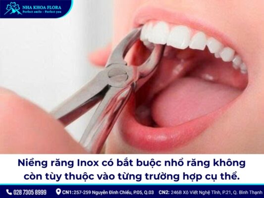 niềng răng inox đơn giản - ảnh 4 niềng răng inox đơn giản - ảnh 4