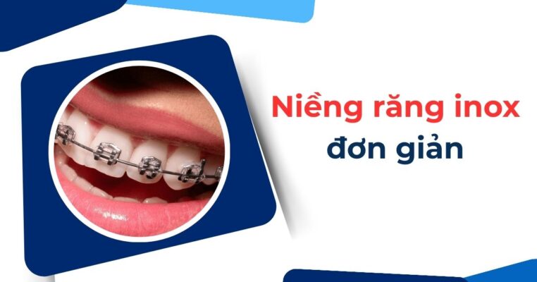 niềng răng inox đơn giản