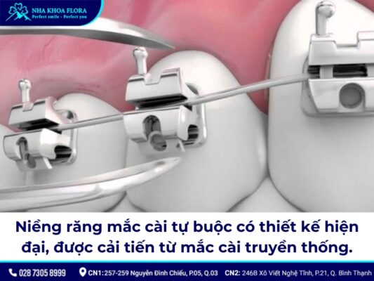 niềng răng mắc cài tự buộc - ảnh 1 niềng răng mắc cài tự buộc - ảnh 1