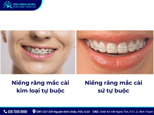 niềng răng mắc cài tự buộc - ảnh 2 niềng răng mắc cài tự buộc - ảnh 2