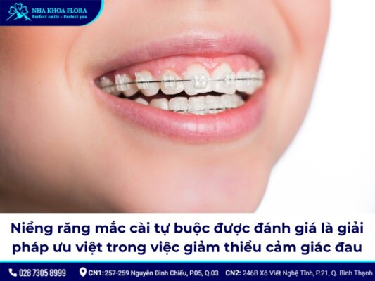 niềng răng mắc cài tự buộc - ảnh 3 niềng răng mắc cài tự buộc - ảnh 3
