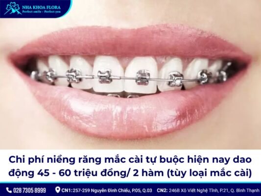 niềng răng mắc cài tự buộc - ảnh 4 niềng răng mắc cài tự buộc - ảnh 4