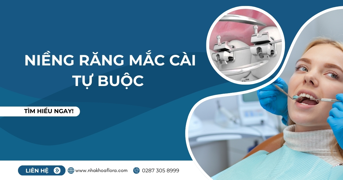 Niềng răng mắc cài tự buộc là gì? Phân loại? Giá bao nhiêu?