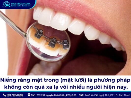 niềng răng mặt trong - ảnh 1 niềng răng mặt trong - ảnh 1