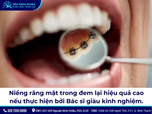 niềng răng mặt trong - ảnh 2 niềng răng mặt trong - ảnh 2