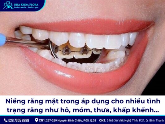 niềng răng mặt trong - ảnh 3 niềng răng mặt trong - ảnh 3