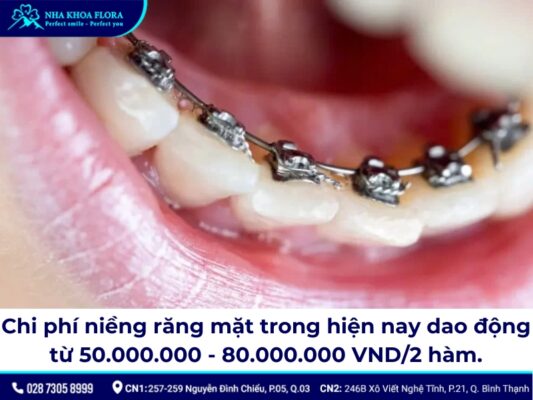 niềng răng mặt trong - ảnh 4 niềng răng mặt trong - ảnh 4
