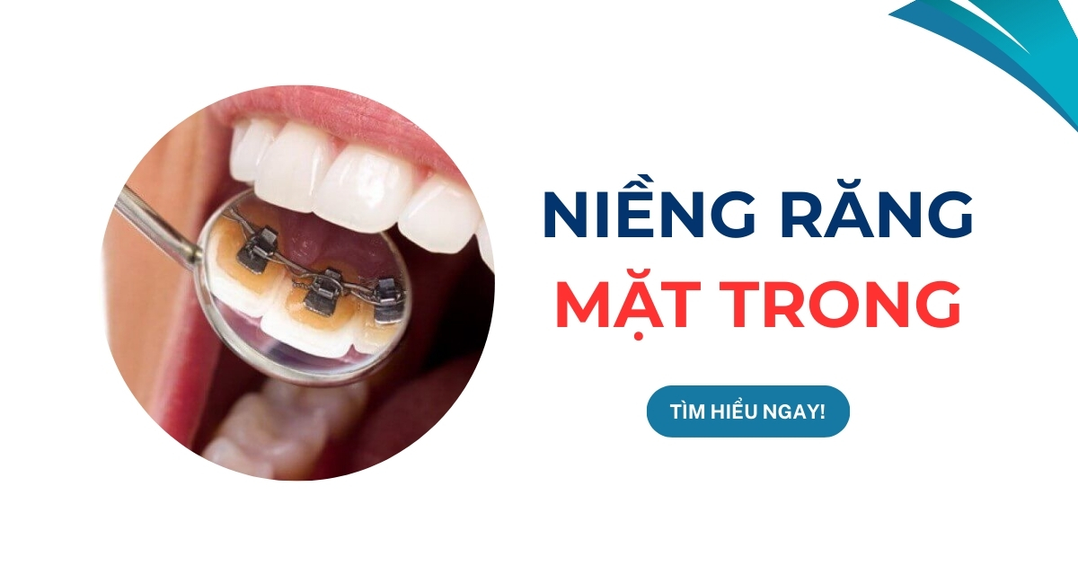 Niềng răng mặt trong cho các trường hợp nào? Giá bao nhiêu?