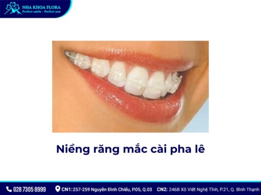 niềng răng pha lê và sứ - ảnh 1 niềng răng pha lê và sứ - ảnh 1