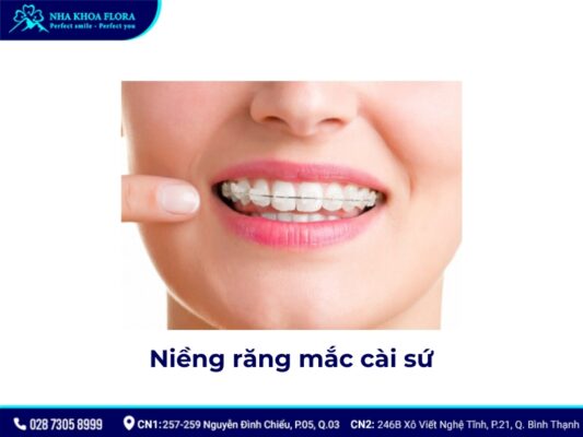 niềng răng pha lê và sứ - ảnh 2 niềng răng pha lê và sứ - ảnh 2