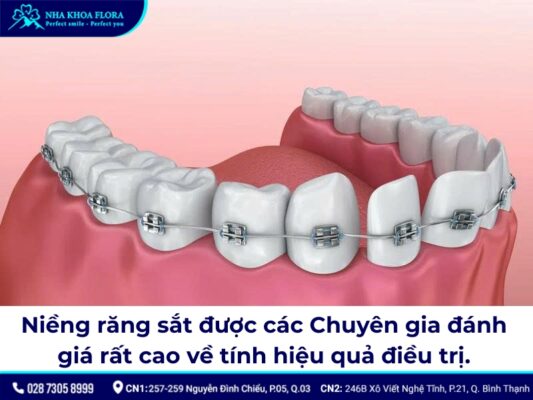 niềng răng sắt - ảnh 2 niềng răng sắt - ảnh 2