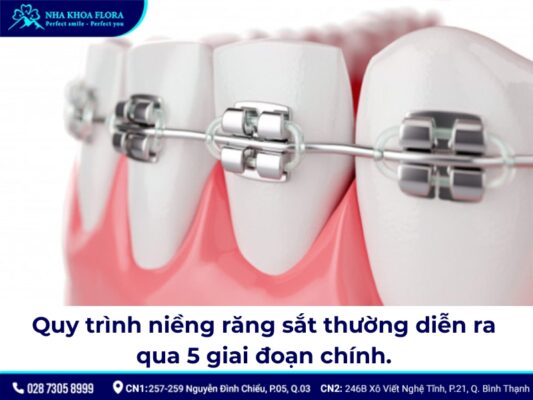 niềng răng sắt - ảnh 4 niềng răng sắt - ảnh 4
