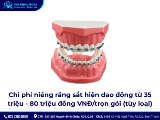 niềng răng sắt - ảnh 5 niềng răng sắt - ảnh 5