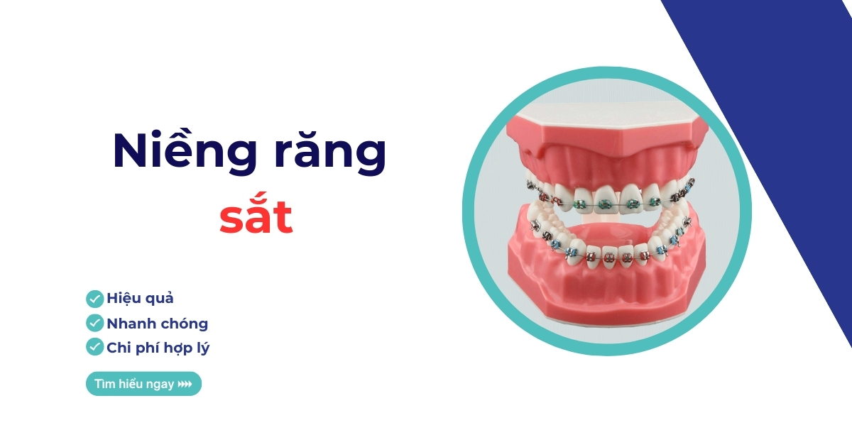 Niềng răng sắt là gì? Có hiệu quả không? Giá bao nhiêu?