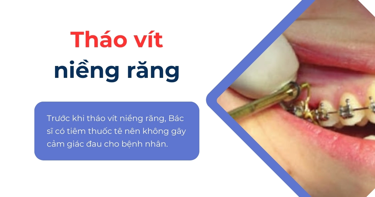 Tháo vít niềng răng khi nào? Có đau không? Cần lưu ý gì?