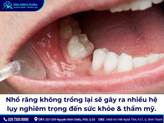Nhổ răng không trồng lại có sao không? - ảnh 2 Nhổ răng không trồng lại có sao không? - ảnh 2