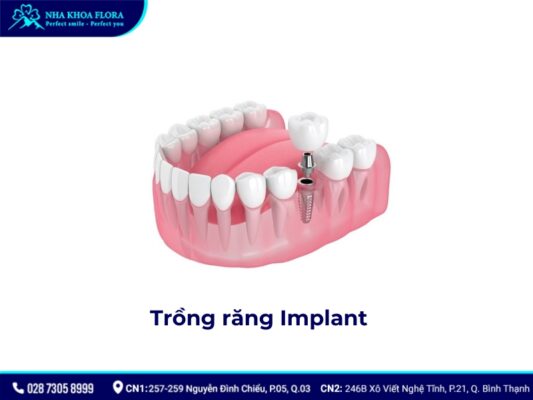 Nhổ răng không trồng lại có sao không? - ảnh 6 Nhổ răng không trồng lại có sao không? - ảnh 6