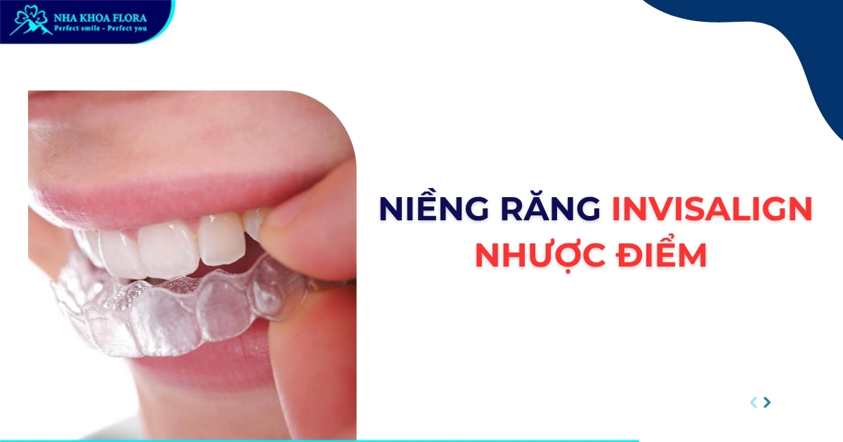 Niềng răng Invisalign nhược điểm bạn cần tham khảo trước