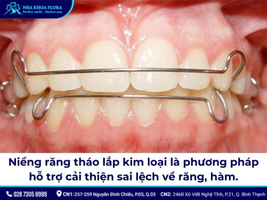niềng răng tháo lắp kim loại - ảnh 1 niềng răng tháo lắp kim loại - ảnh 1