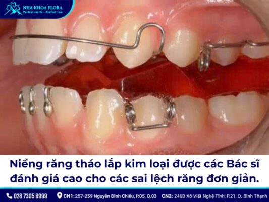 niềng răng tháo lắp kim loại - ảnh 2 niềng răng tháo lắp kim loại - ảnh 2