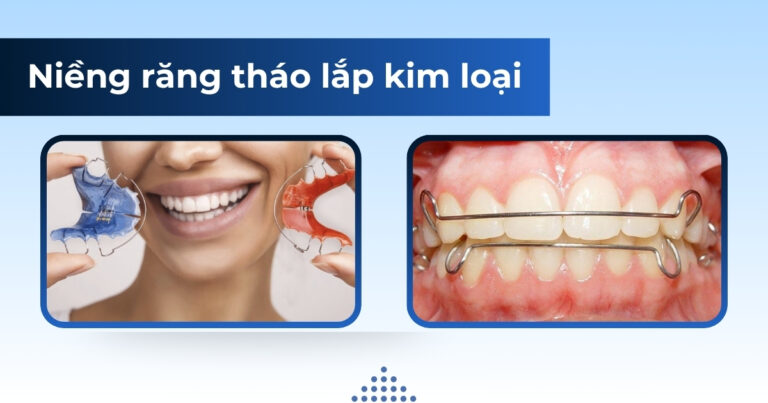 niềng răng tháo lắp kim loại
