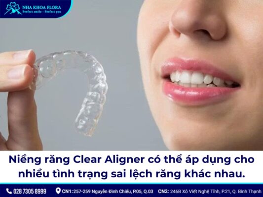 Niềng răng trong suốt Clear Aligner - ảnh 2 Niềng răng trong suốt Clear Aligner - ảnh 2