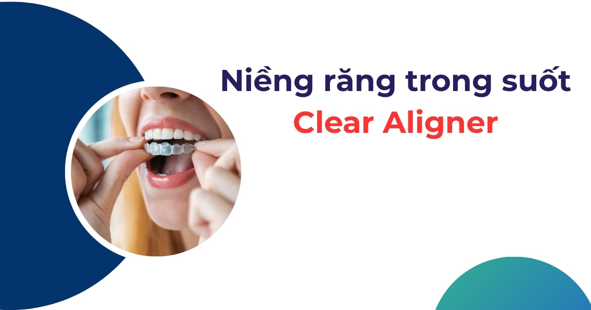 Niềng răng trong suốt Clear Aligner có tốt không? Giá bao nhiêu?