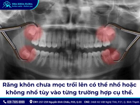 nhổ răng khôn chưa mọc - ảnh 1 nhổ răng khôn chưa mọc - ảnh 1