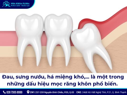 nhổ răng khôn chưa mọc - ảnh 2 nhổ răng khôn chưa mọc - ảnh 2