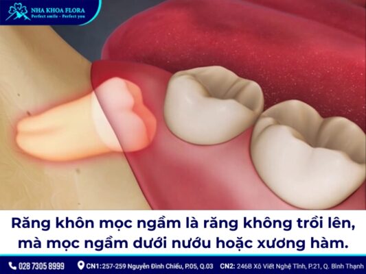 nhổ răng khôn mọc ngầm - ảnh 1 nhổ răng khôn mọc ngầm - ảnh 1