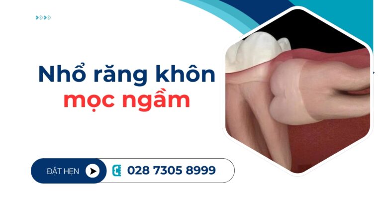nhổ răng khôn mọc ngầm