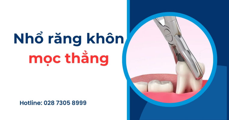 nhổ răng khôn mọc thẳng