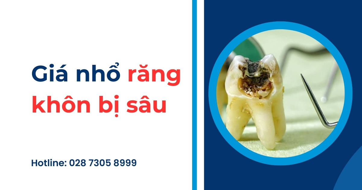 Giá nhổ răng khôn bị sâu bao nhiêu tiền? Bảng giá năm 2025