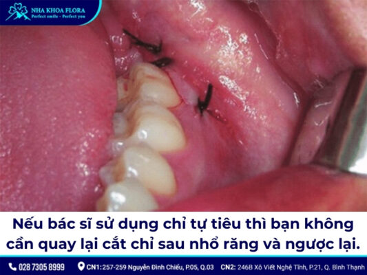 nhổ răng khôn bao lâu cắt chỉ - ảnh 2