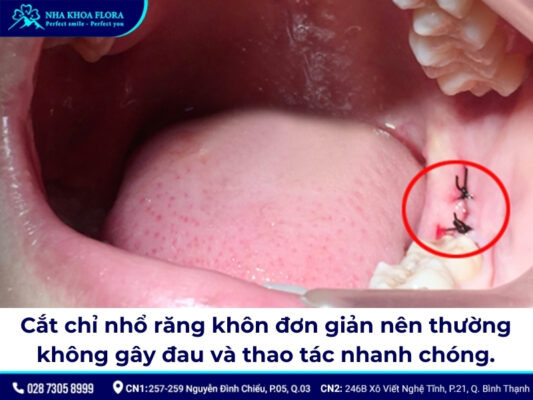 nhổ răng khôn bao lâu cắt chỉ - ảnh 3
