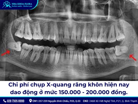 nhổ răng khôn có cần chụp x quang không - ảnh 4 nhổ răng khôn có cần chụp x quang không - ảnh 4