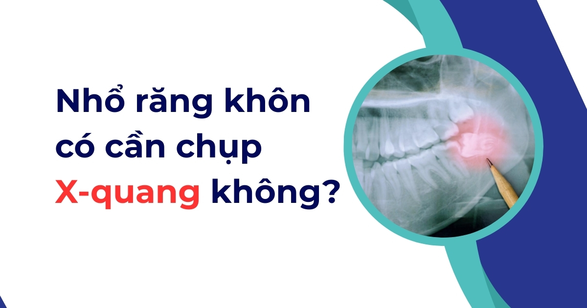 Nhổ răng khôn có cần chụp X quang không? Giá bao nhiêu?