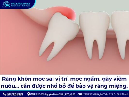 nhổ răng khôn khi đang bị đau - ảnh 3 nhổ răng khôn khi đang bị đau - ảnh 3