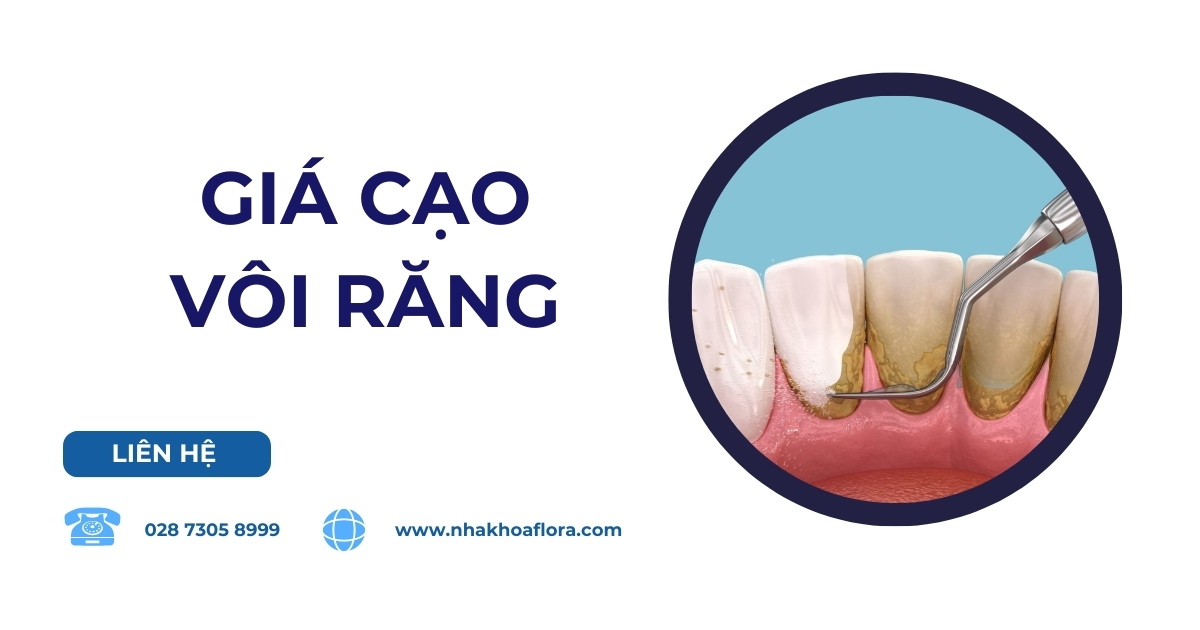 Giá cạo vôi răng bao nhiêu tiền? Bảng giá mới nhất hiện nay